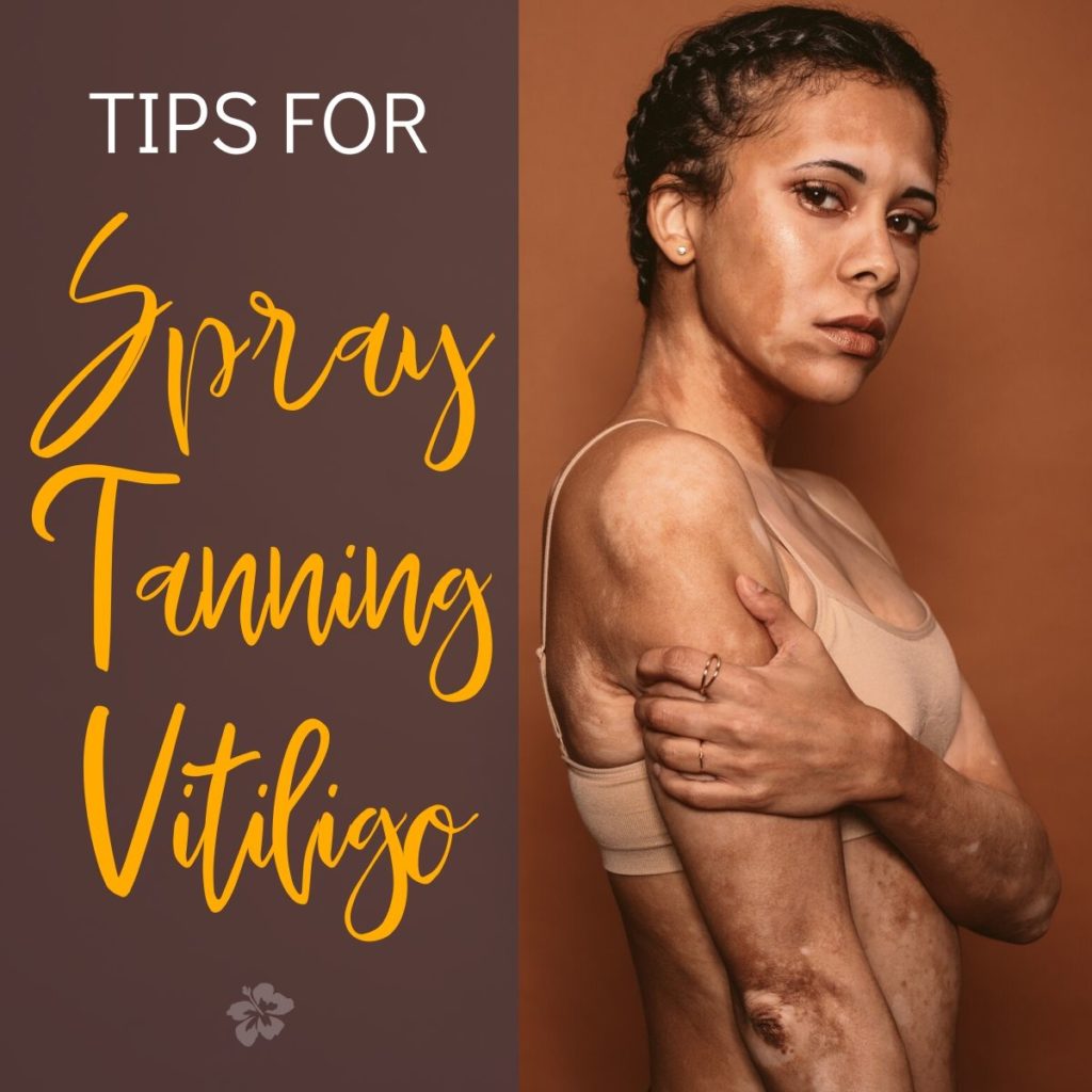 photo of a tan woman with vitiligo