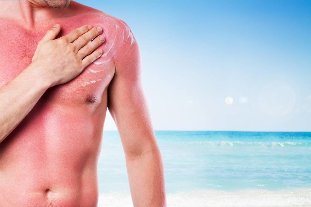 How can I quickly treat sunburn?